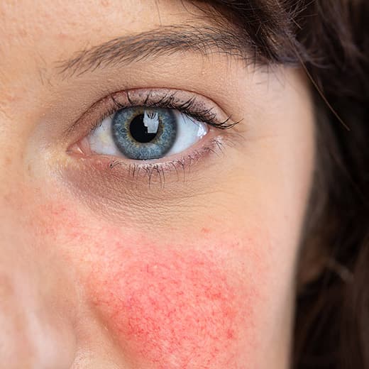 Image of Understanding Rosacea