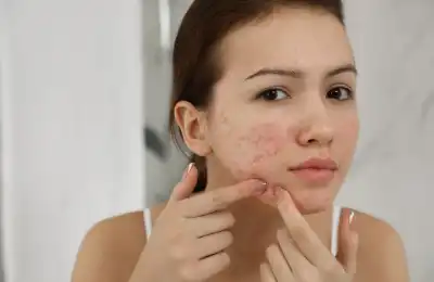 Sandalwood Essential Oil Benefits for Skin