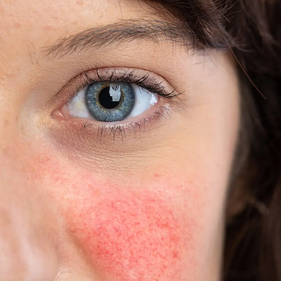 Close-up  of a woman with rosacea