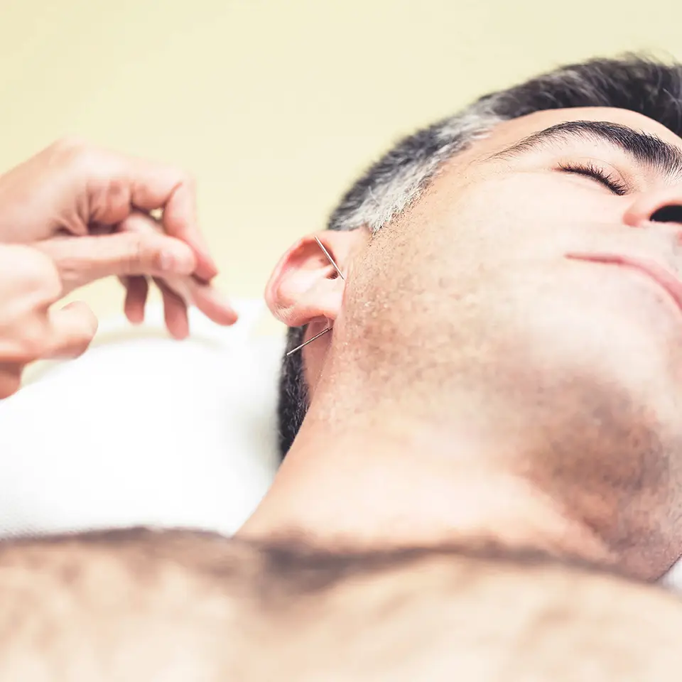 A man receiving auricular therapy, as a therapist applies acupuncture needles to his ear