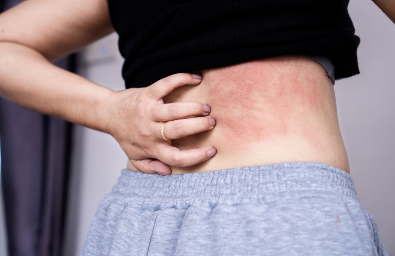 Treating itchy skin with tea tree oil