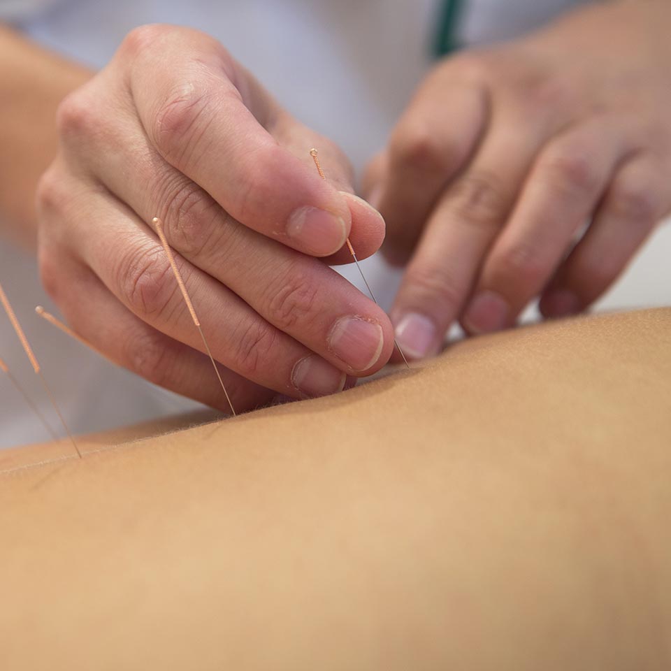 Acupuncture needles being applied.