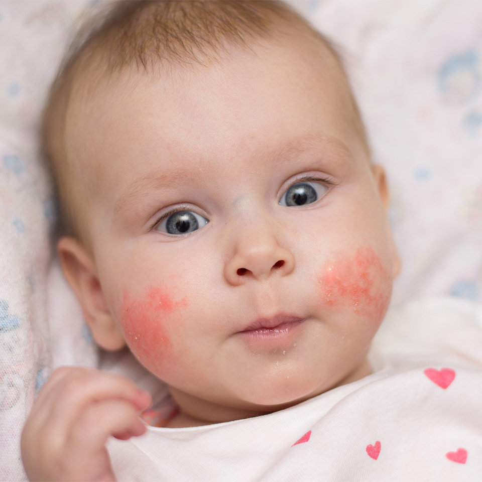 Baby girl with an eczema on her cheeks