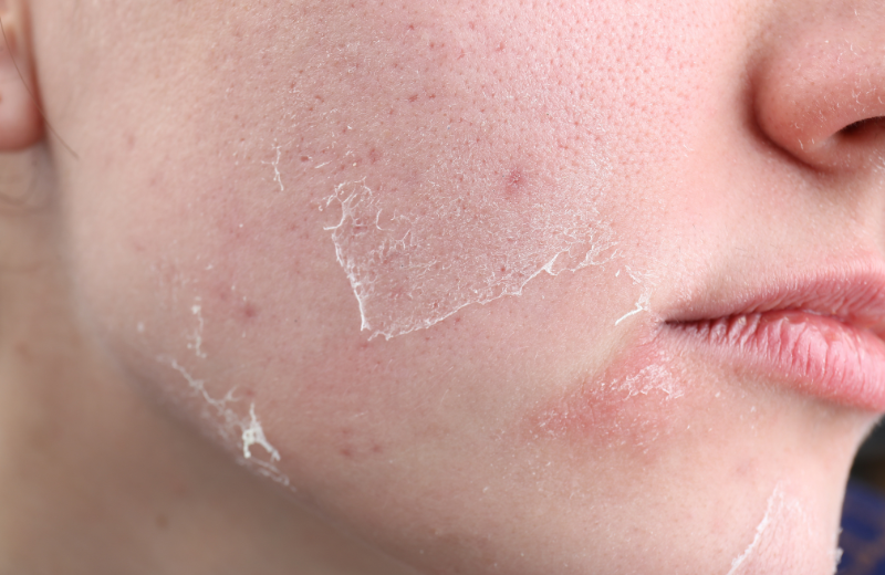 Rose Essential Oil Benefits for Skin