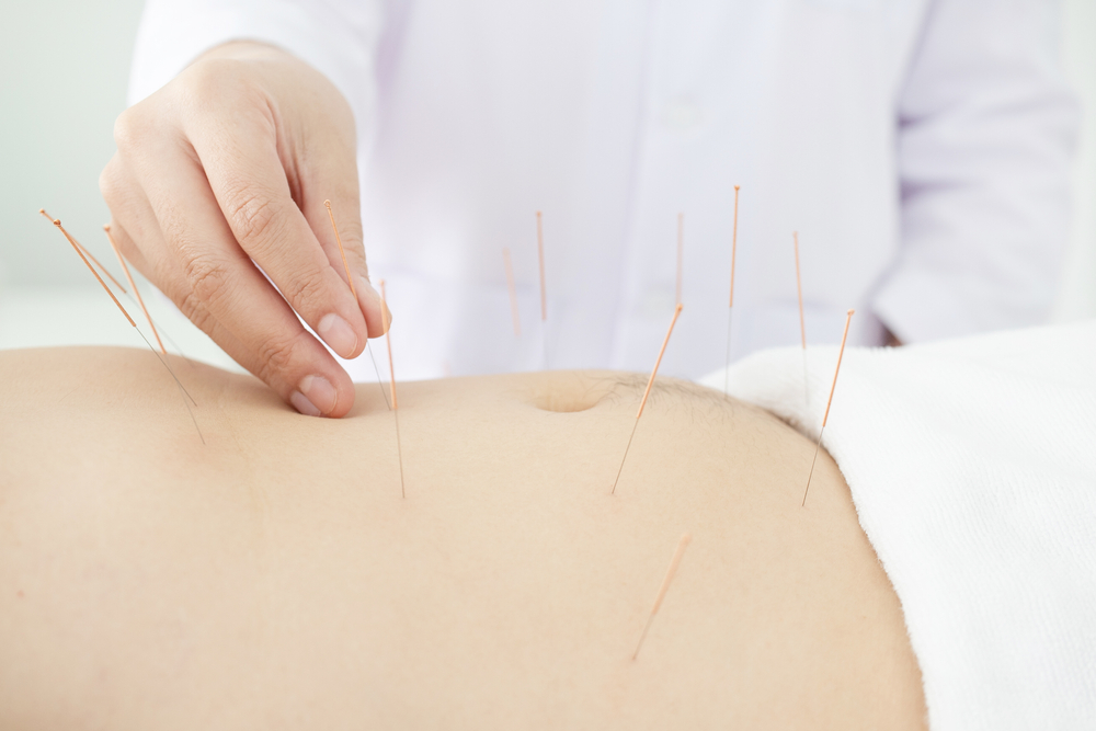 Acupuncture being carried out on the stomach.