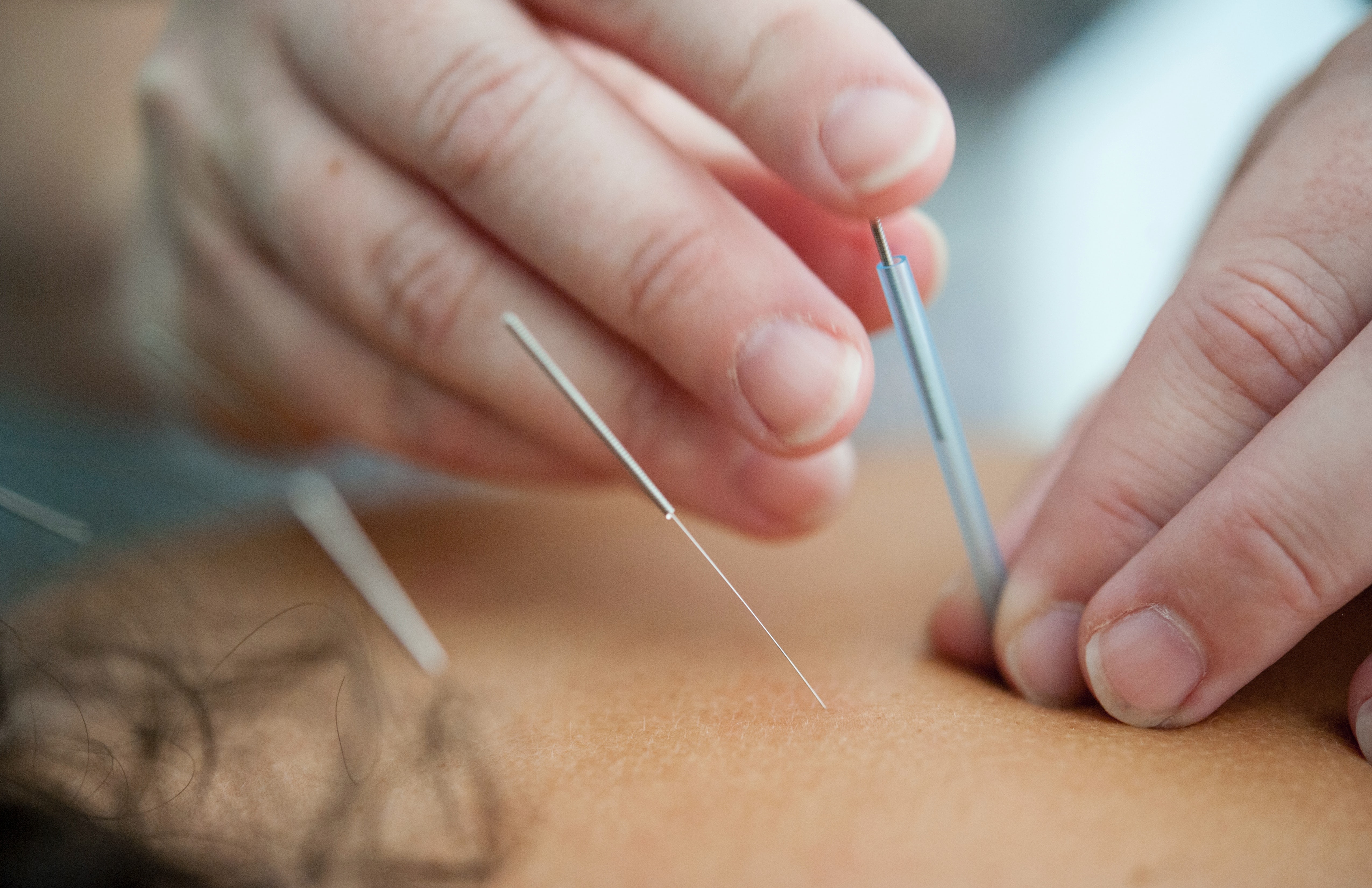 Acupuncture points being utilised for weight loss.