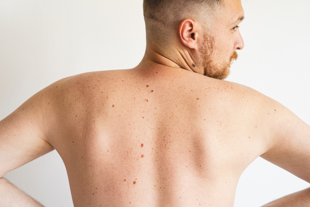 Birthmarks on a man's back
