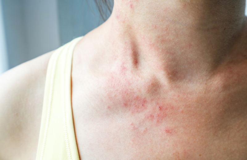 What Are the Side Effects of Black Seed Oil?