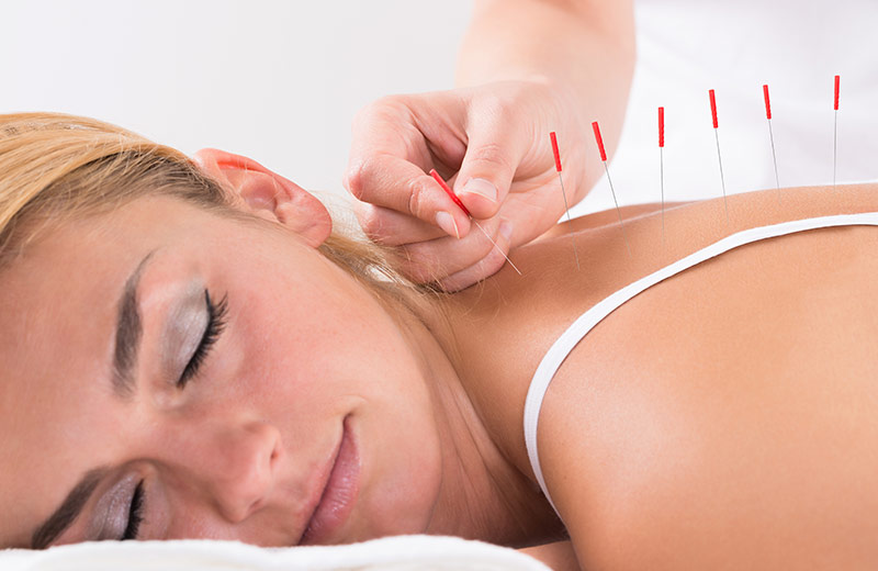 A peaceful-looking woman undergoing acupuncture.
